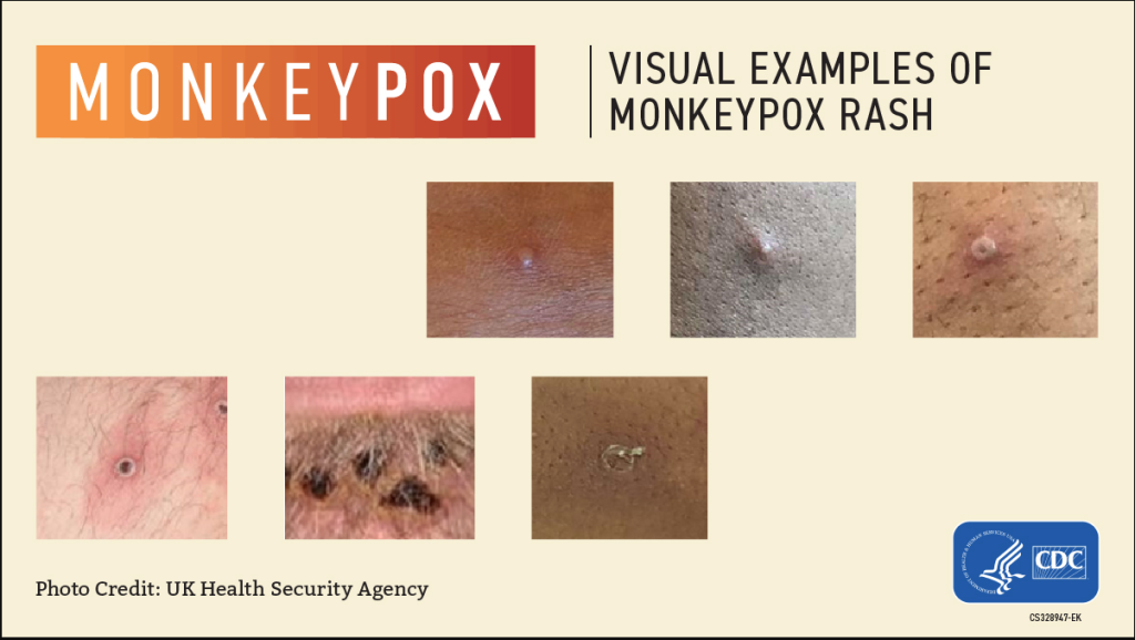 Recognizing Monkeypox - visual examples of Monkeypox