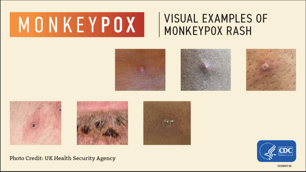 Recognizing Monkeypox in Early Child Care Child Care Aware